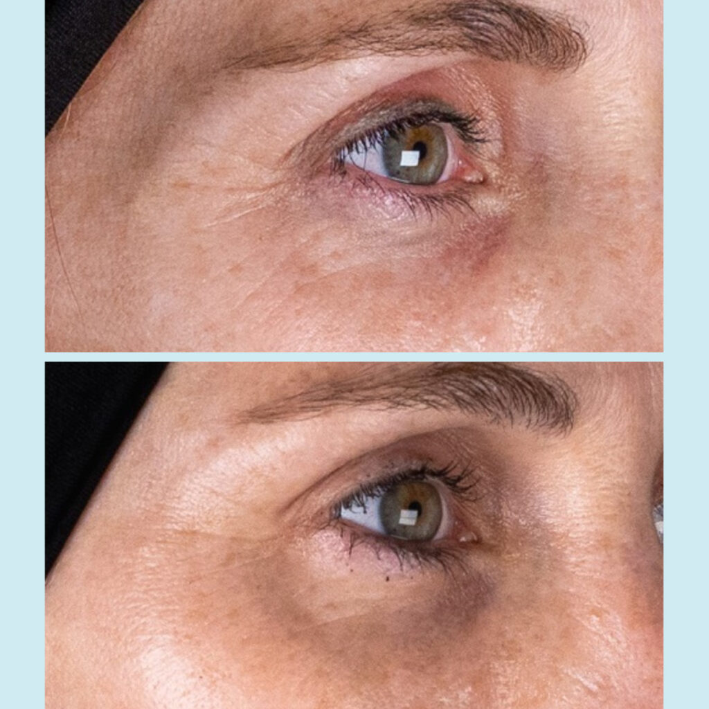 Tratamiento del contorno de ojos con ácido hialurónico no reticulado y vitaminas, Eyelid Vital. Doctora Escoda Barcelona