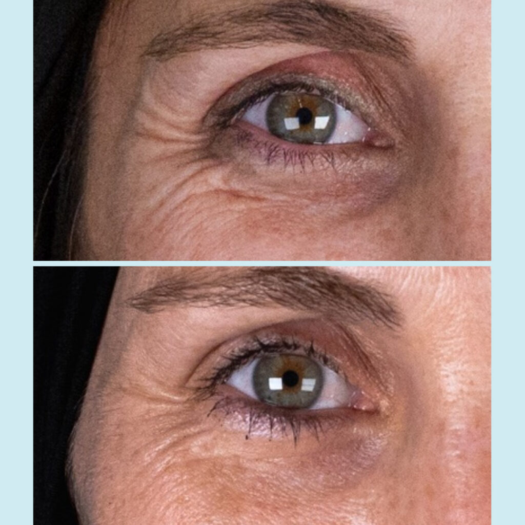 Tratamiento del contorno de ojos con ácido hialurónico no reticulado y vitaminas, Eyelid Vital. Doctora Escoda Barcelona